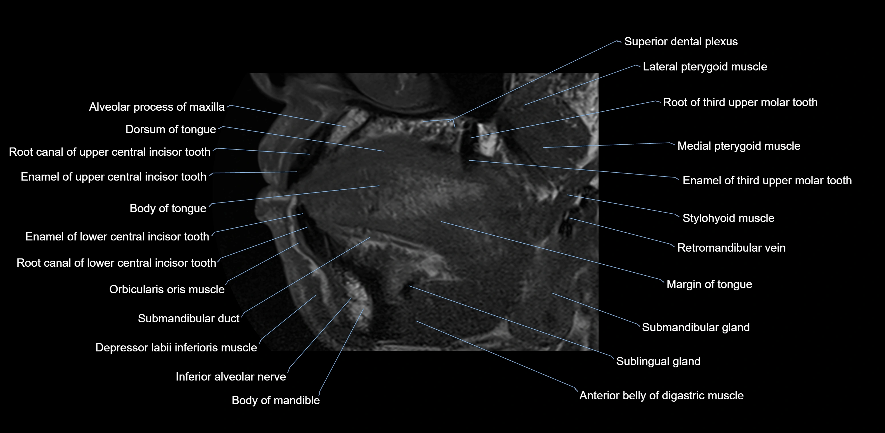 Dental MRI( tooth) sagittal labelled  cross sectional 3T anatomy -img-00001-00012.webp